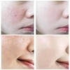 Salicylic Acid Concentrate Super Strong 2% - Acne Spot Treatment