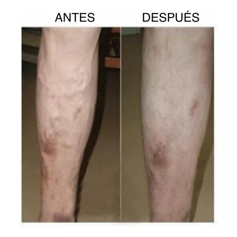 DOREAN Eliminador De Cicatrices Espinillas Estrias Y Varices