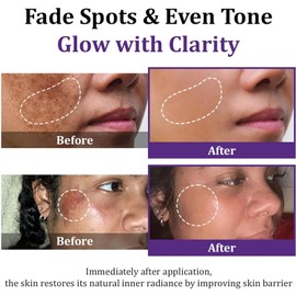 Advanced Anti Hyperpigmentation Cream, 20g Hyperpigmentation Treatment Facial Cream, Deep Cleansing Dark Spots Remover Corrector for Face, Brightening Anti Pigmentation Removal Cream