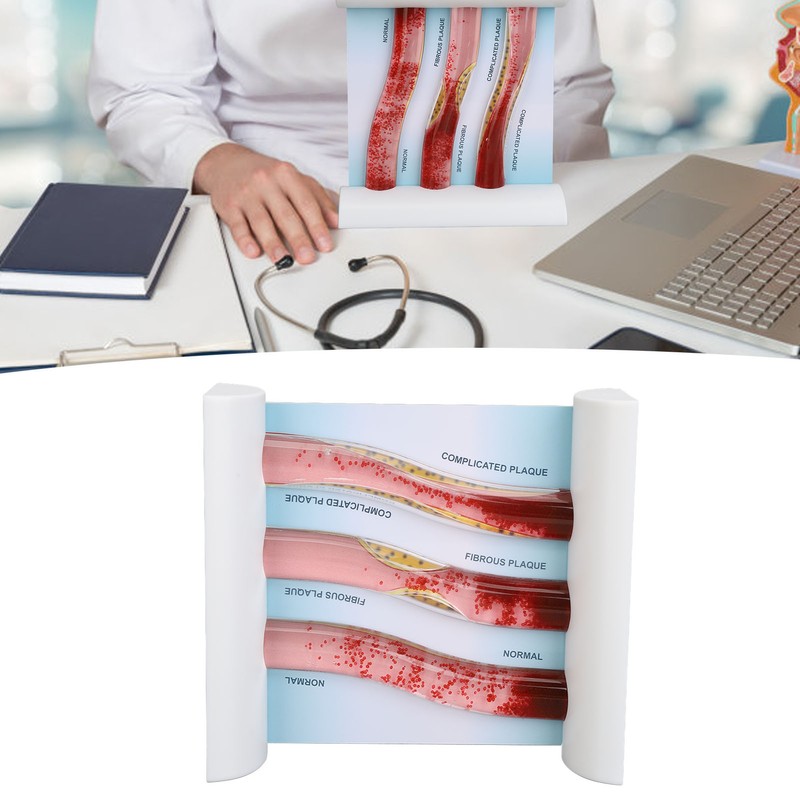 Lipoprotein LDL Blood Vessel Model Low Density Blood Lipid Vessel