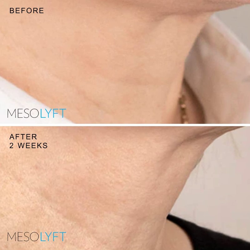 Mesolyft Neck & Lip Plumper Combo with Roller to Instantly