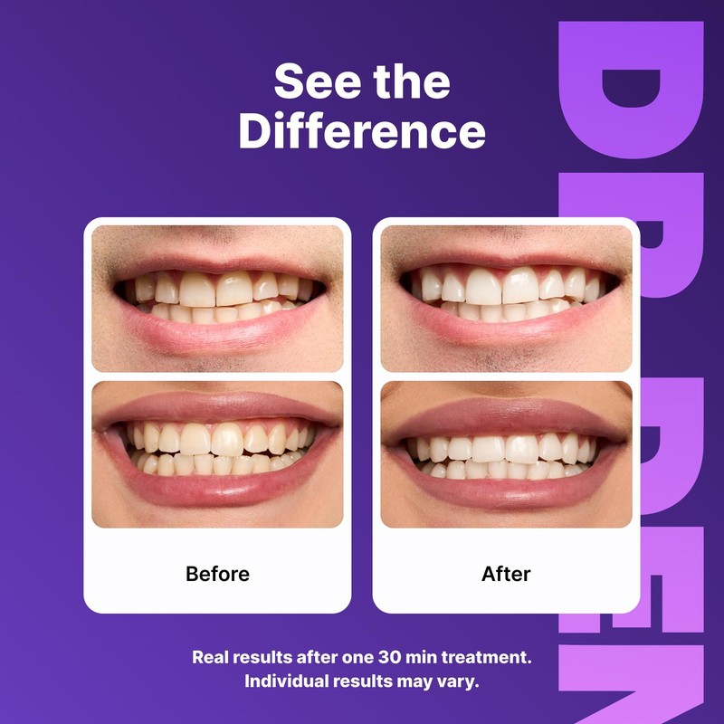 DRDENT Purple Teeth Whitening Strips - 21 Uses - Gentle