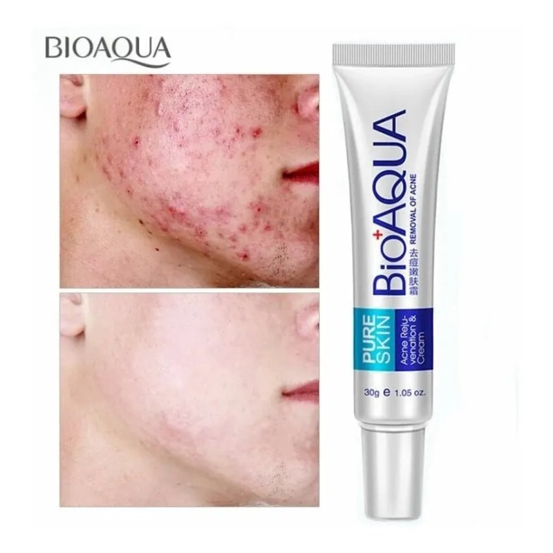 Bioaqua Crema Eliminación Acné Granos En Piel Cierra Poros