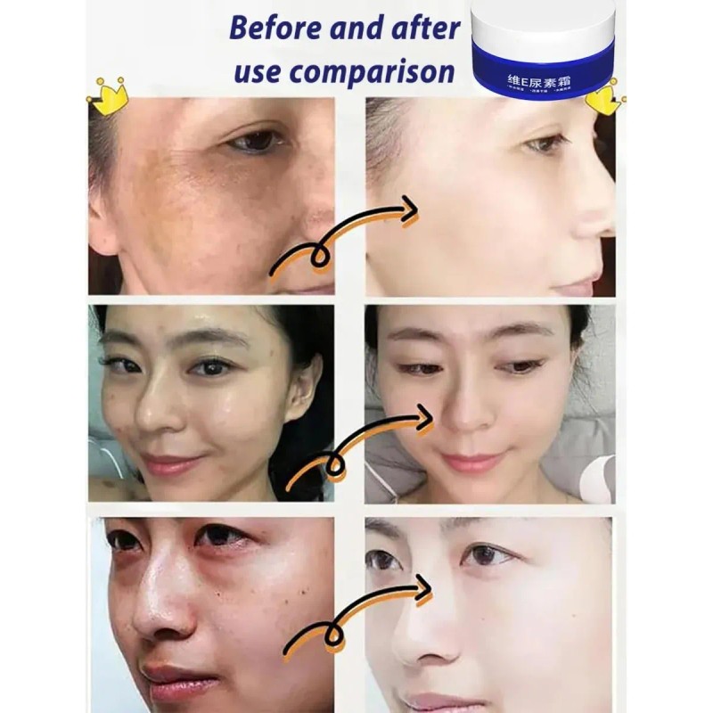 Crema De Urea Para Aclarar Manchas Y Reducir Arrugas.