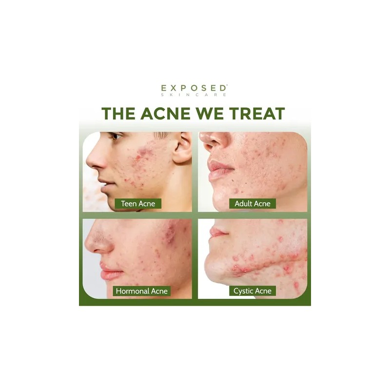 Exposed Skin Care Tónico Facial Clearing Tonic Con Ácido Sal