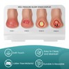 MedEduQuest Heel Pressure Injury Stages Model, Ulcer Demonstration Model