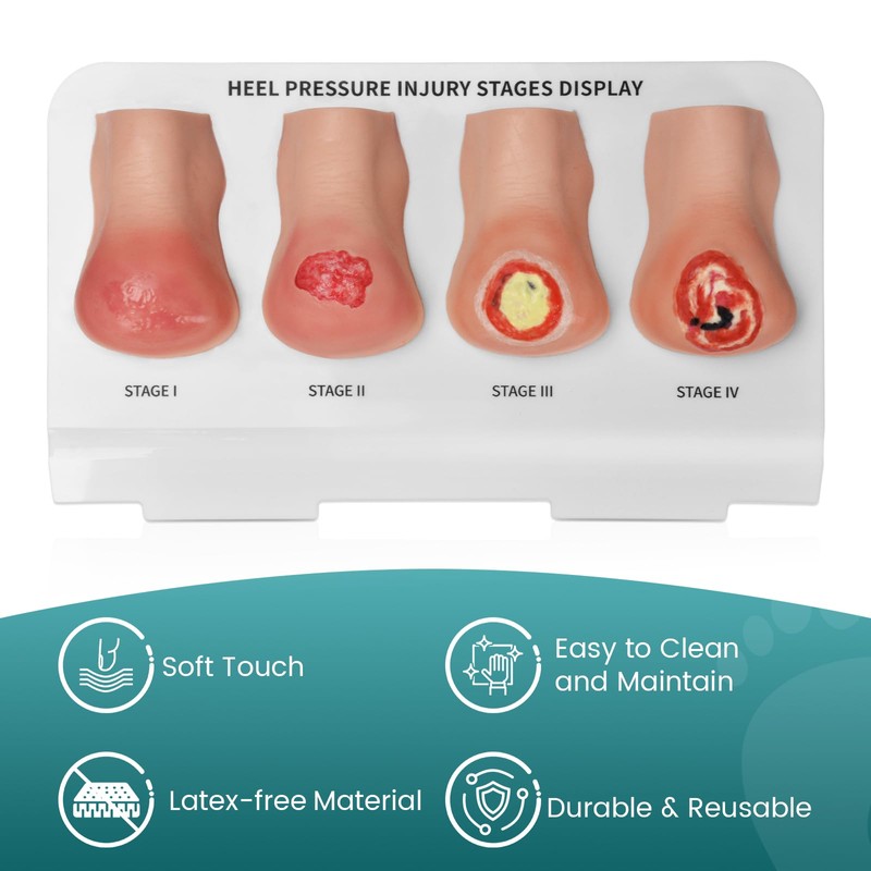 MedEduQuest Heel Pressure Injury Stages Model, Ulcer Demonstration Model