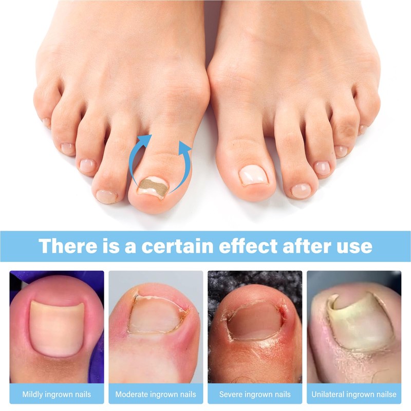 50 Pcs No Glue Breathable Corrector Patch,Painless ingrown toenail Corrector,Nail