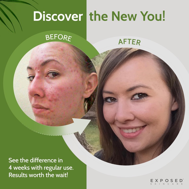 Exposed Skin Care Probiotic Supplement Complex with 1 Billion CFU