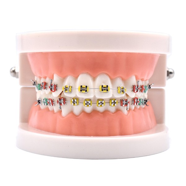 Angzhili 1 Piece Dental Demonstration Orthodontic Model with Metal Wires and Bracket (Metal bracket)