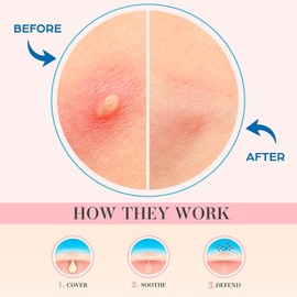 OUKEYA Pimple Patches For Face: Emergency Spot Patch Hydrocolloid Acne Pimple Patch for Covering Zits and Blemishes Spot Stickers for Face and Skin 36 Patches