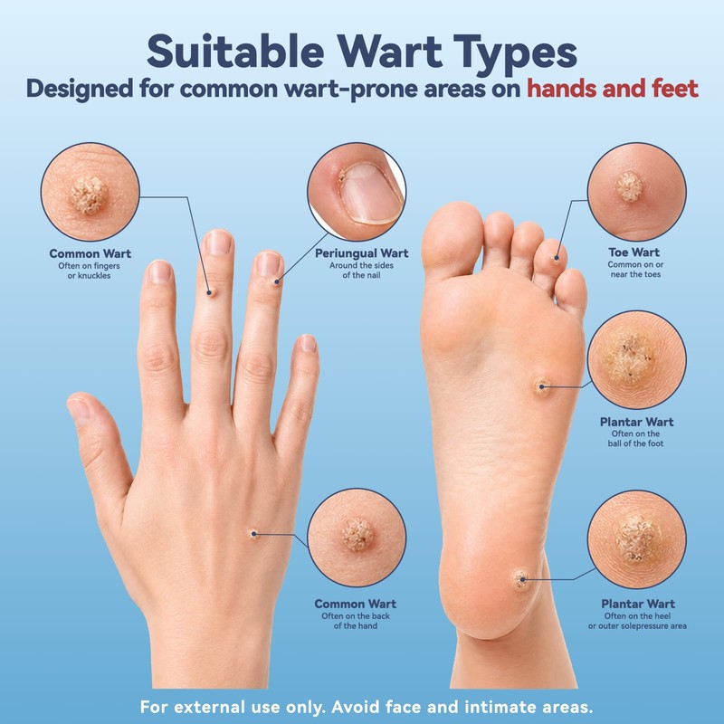 BPLXKUR Wart Remover – Gentle OTC with Natural Plant Extracts,