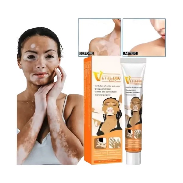 2 Cremas Vitiligo Tratamiento Premium Para La Piel. Todo Tipo