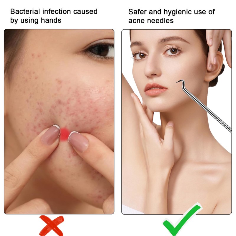 DHWEKU 4 Pieces Blackhead Remover Comedone Squeezer Kit, Blackhead Remover