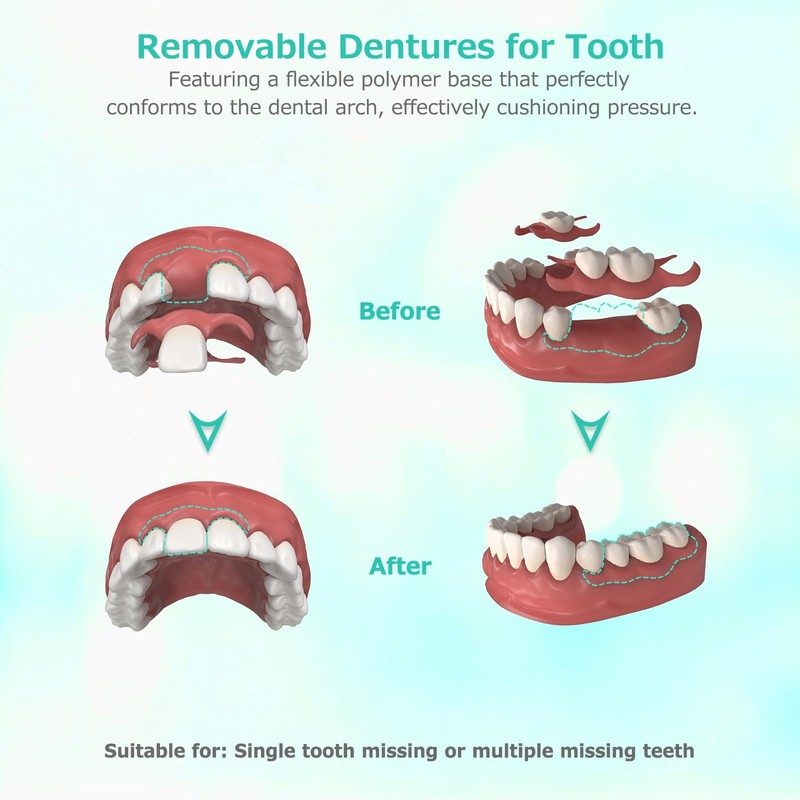Custom Partial Dentures for Missing Teeth, Removable Dentures for Teeth,