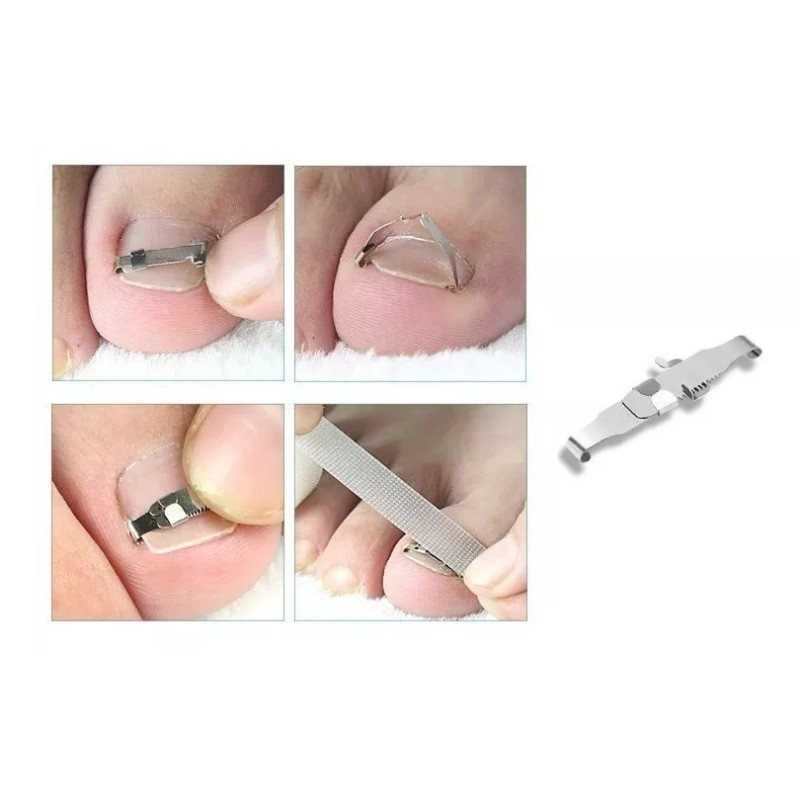 INVDISA Par De Corrector De Uñas Encarnadas - N U