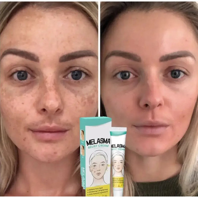Crema Despigmentante Para Manchas,melasma, Acné Y Paño 2pzs