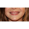 Snapcaps Braces Bumper Cover, Orthodontic Bracket Wax Substitute, Alternative Snap-on