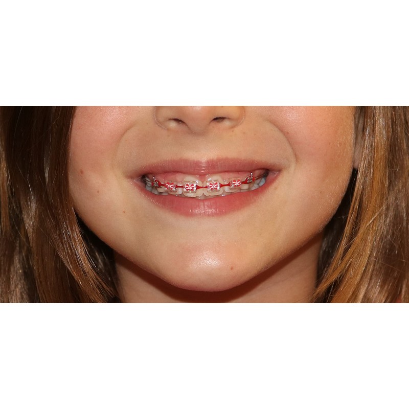 Snapcaps Braces Bumper Cover, Orthodontic Bracket Wax Substitute, Alternative Snap-on