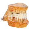 Dental Model Dental Disease Teaching Model Removable Implant Teeth Model