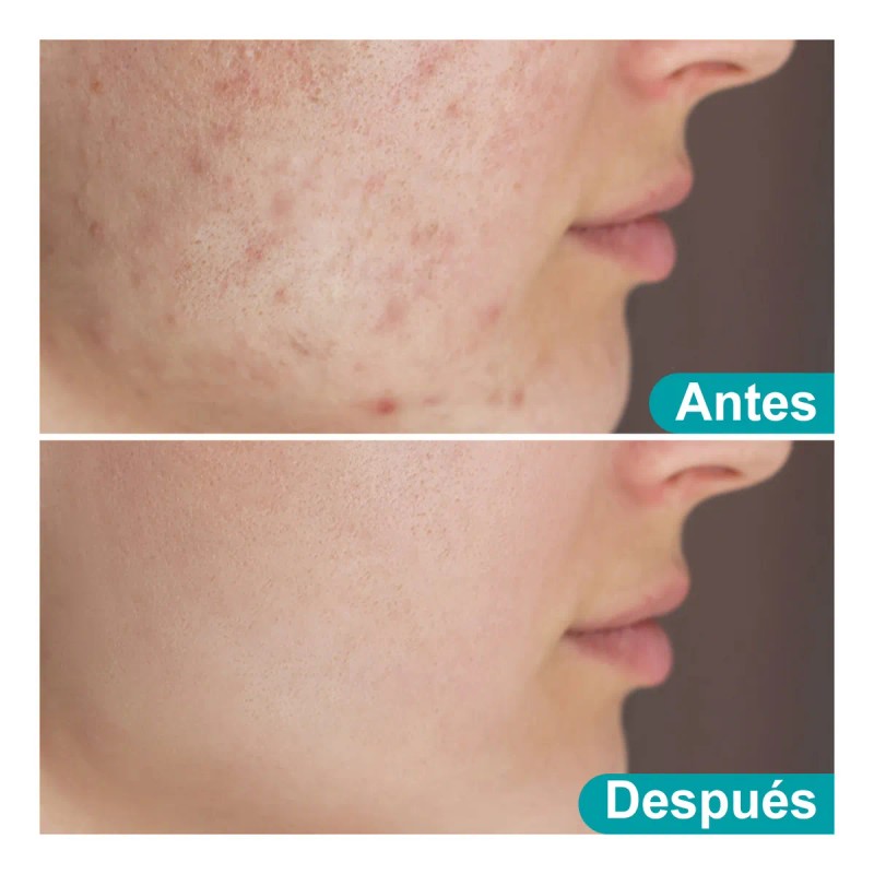Gel Contra Barros Y Espinillas Tipo De Piel Con Acné,