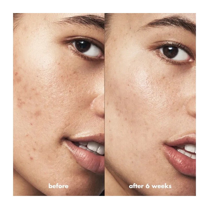 E.l.f. Skin Blemish Breakthrough - Gel Para Combatir El Acné