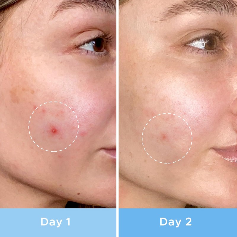 LiBear Pimple Patches, Upgraded Invisible Acne Cover Patch, Hydrocolloid Acne