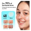 Parches De Espinilla De Tktk, Parches De Acné Invisibles De