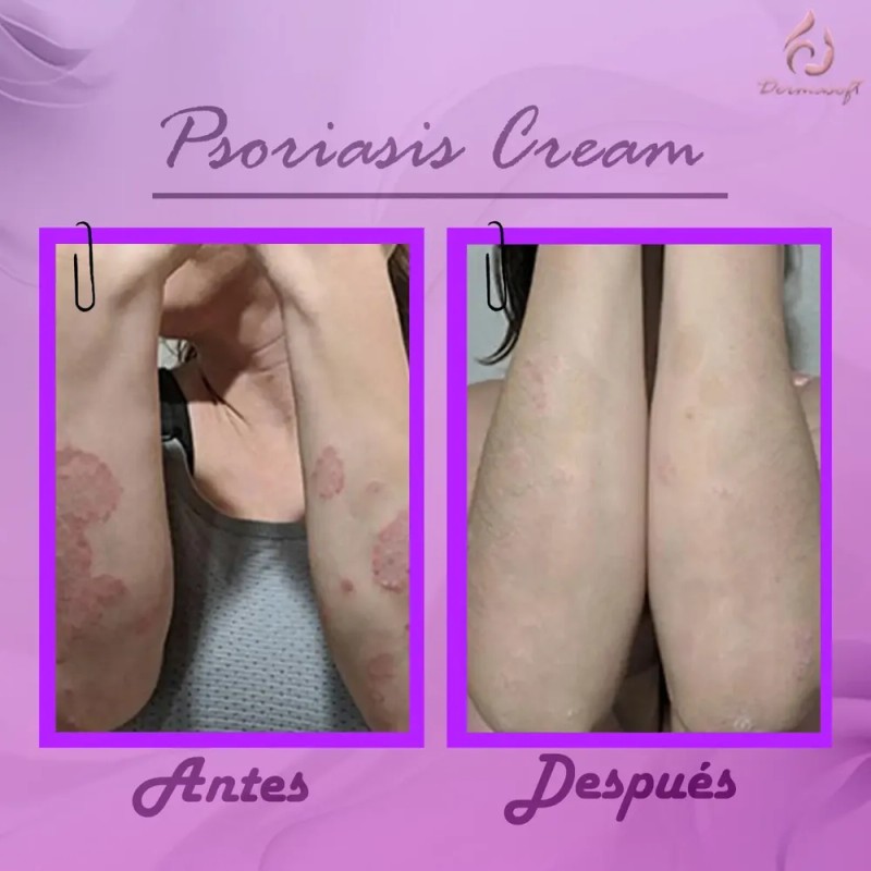 Crema Facial & Corporal Psoriasis Cream Hidratante Aliviante