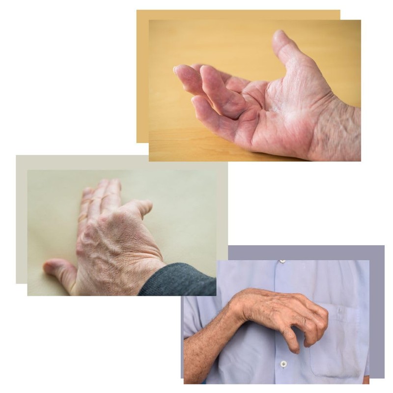 Restorative Medical BendEase Hand Splint - Wrist Pain Support for