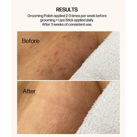 VMAGIC® Ingrown Prevention Duo