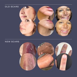 ESTAS Beauty Scar Cream On The Go -Daily Vitamin E & C with Silicone, For Old & New Scars on Face & Body, Ideal For Surgical, Burn, C-Section & Acne Scars, Vegan + Cruelty Free, (0.17oz pack of 3)