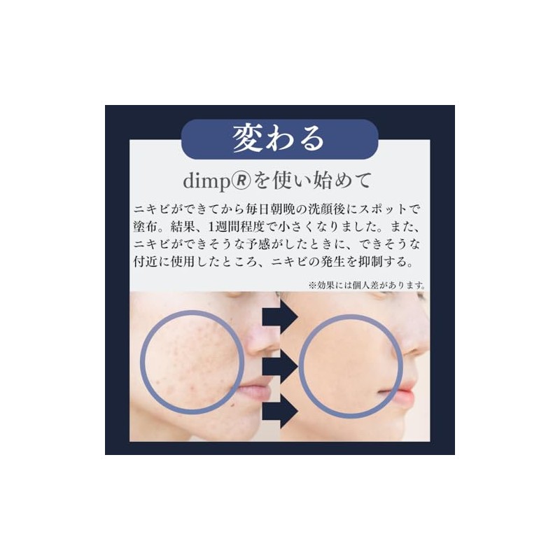 大容量 ニキビ 薬 跡 【医薬部外品ｘ薬用アクネジェルｘdimpｘ保湿ｘ抗炎症ｘ殺菌​トリプル処方ｘジェルｘメンズｘレディースｘ思春期ｘ大人男性ｘ大人女性ｘ毛穴ケアｘにきび予防ｘニキビ跡】１００ｇｘさわやかハスの香り