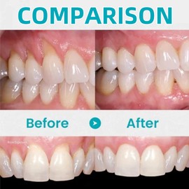 2PCS Gum Repair Gel Treatment,Gum Repair for Receding Gu-Ms,Teeth Re-Pair Gel,Gu-M Shield Therapy G-El,Teeth Brightening Essence Pen,Instant Treatment,Protect Oral Care,Deeply Cleaning,Fresh Breath