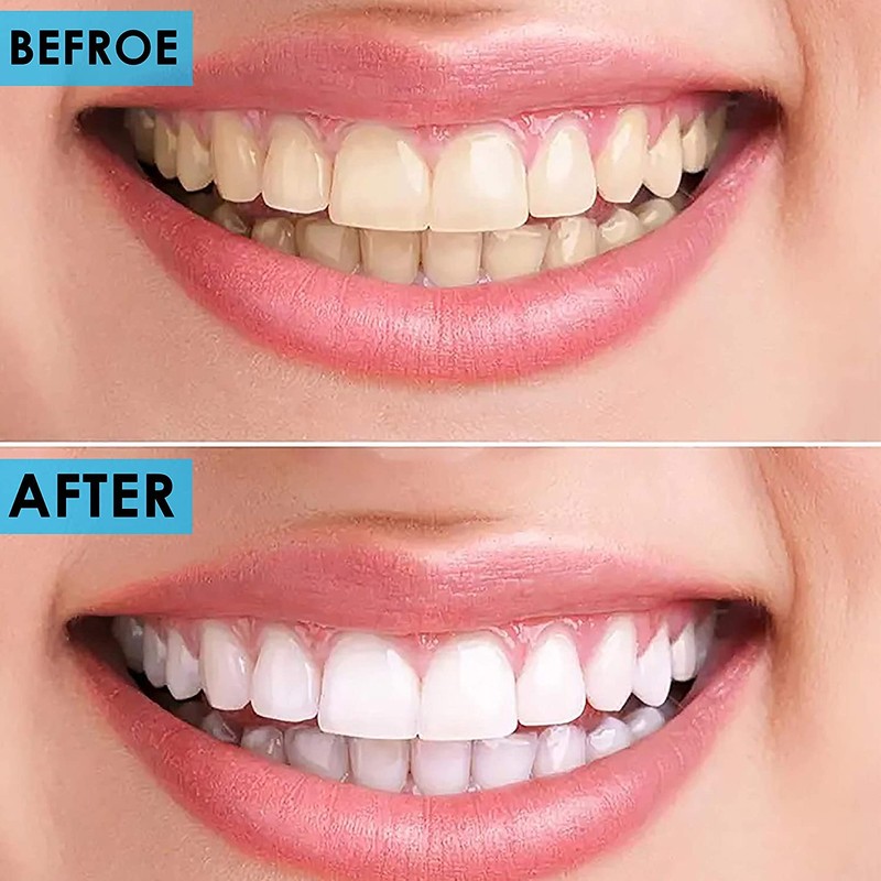 Candure Professional Dental Probes for Cleaning Stainless Steel Teeth Whitening