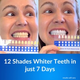 Polar MD Teeth Whitening Kit, Professional Teeth Whitener Gel Pens, 1YR. Supply, Compare to Whitening Strips. Powerful 32 LED Wireless Activating Light.