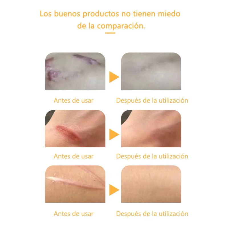 Crema Para Eliminar Cicatrices Quirúrgica Crema Para Estrias
