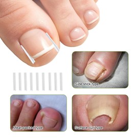 100pcs Ingrown Toenail Corrector,Toenail Brace,Ingrown Toenail Corrector Treatment Set,Ingrown Toenail Tool,Suitable for Foot Care,with 50 Card Slots,1 Nail Clipping Box and 1 Corrector