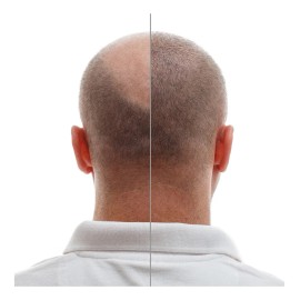 Dutasterida 0.5mg 100 Tabletas Dutaheal Sabor Sin Sabor