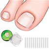 (30+2) Pack Ingrown Toenail Correction Treatment Kit, 30PCS Ingrown Toenails