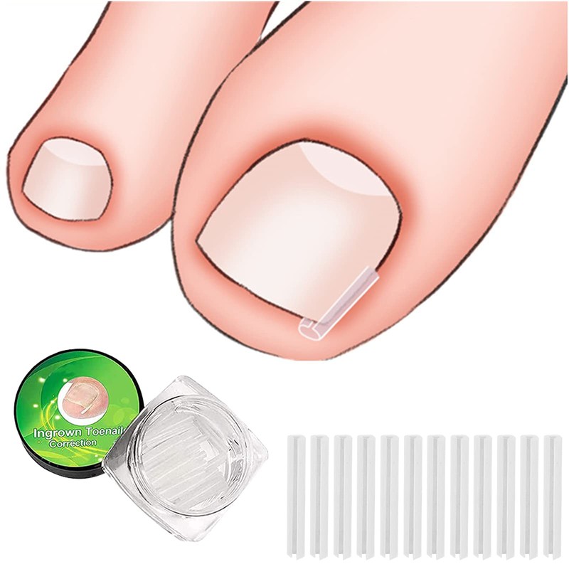 (30+2) Pack Ingrown Toenail Correction Treatment Kit, 30PCS Ingrown Toenails