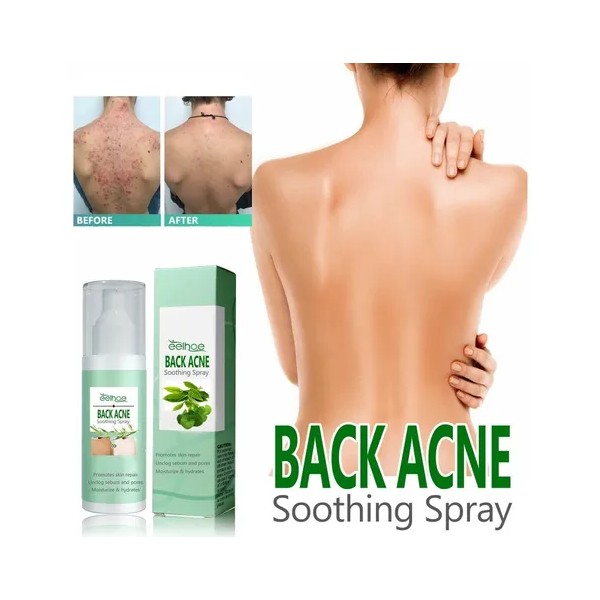 Esencia En Aerosol Para Eliminar El Acné, La Espalda Y
