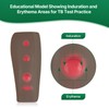 Ultrassist Tuberculosis(TB) Test Palpable Arm Set - Realistic Dual-Tone Training
