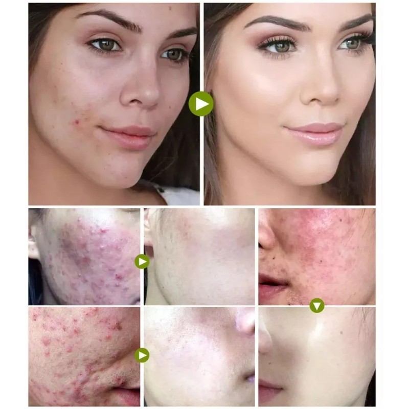 Tratamiento Acne Puntos Negros Manchas Cicatrices Barros