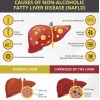 Limpieza del hígado apoyo de salud para eliminar hierba limpieza