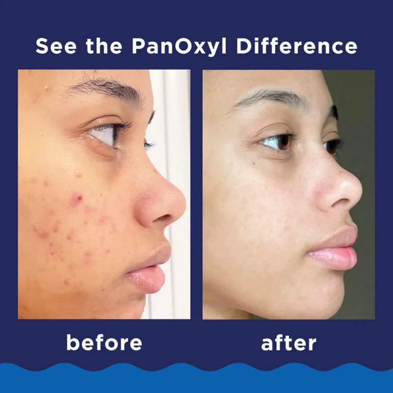 Jabón Facial Espumoso For Acné Yao Panoxyl Con Peróxido De