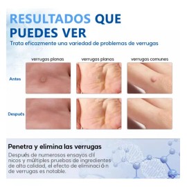 Líquido De Verruga Para Verrugas Cuerpo,cuello 10ml(0.35oz)