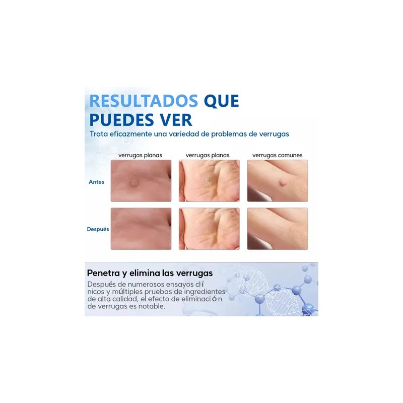 Líquido De Verruga Para Verrugas Cuerpo,cuello 10ml(0.35oz)