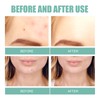 396Pcs Blemish Patches Facial Pimple Zit Spot Stickers Mild Non