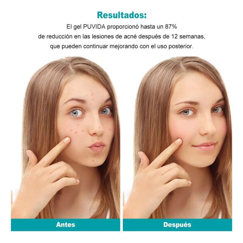 Gel Contra Barros Y Espinillas Tipo De Piel Con Acné,